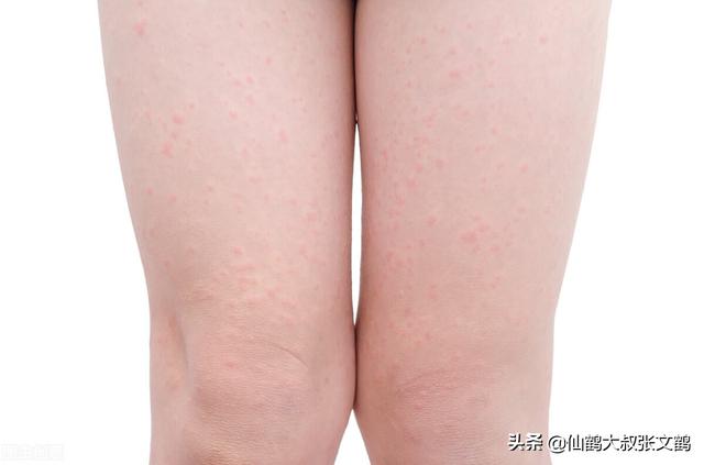 毛质角化症高原红