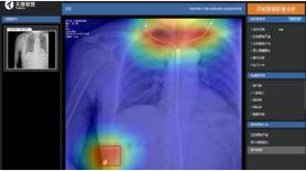 天医云智慧医疗再发力，人工智能精准赋能医学影像