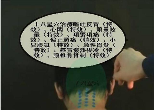 中医针灸颈部疾病处方1