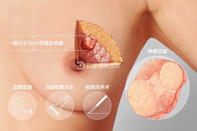 胸部有硬塊，是長了腫瘤嗎？這三步讓你充分了解自己的乳房，提高防癌意識