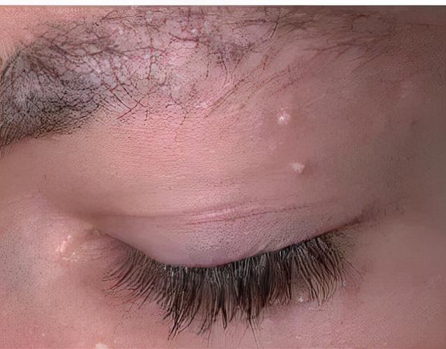 眼周的小颗粒 究竟是什么玩意 太阳信息网