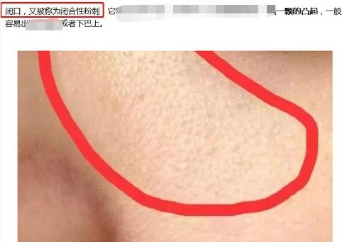 维a酸和果酸鸡皮肤哪个效果好