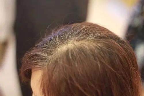 “气血不足”的人容易白发丛生？这4种食物或可“补气养血”