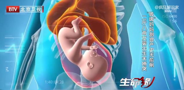 身高89厘米，体重58斤，“玻璃”妈妈冒死生下女儿！纪录片