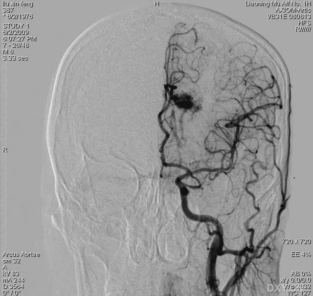脑血管硬化变脆，易发中风，怎么判断？如何预防？