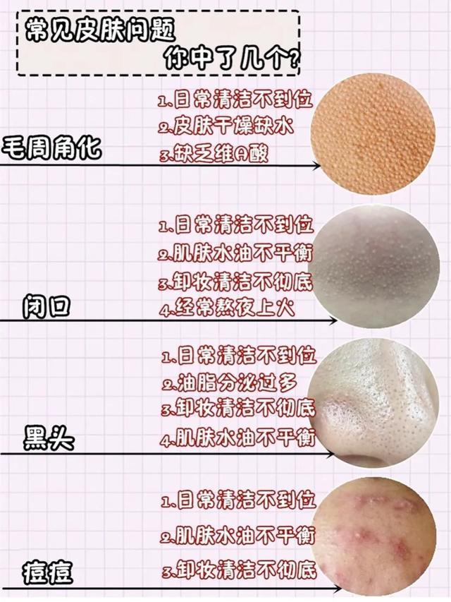 维a酸乳膏可以去周角化
