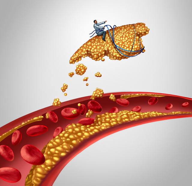 60岁后，体检查出颈动脉斑块，到底要不要治疗呢？