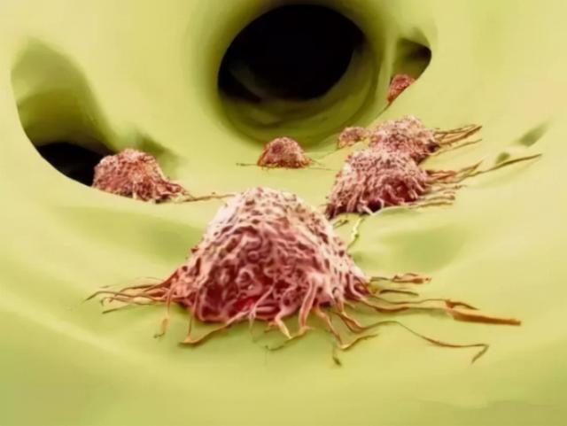 癌症“候选人”，吃饭一般有4个共性，若你有需要改掉