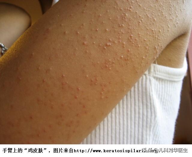孩子皮肤粗糙鸡皮疙瘩一样还痒