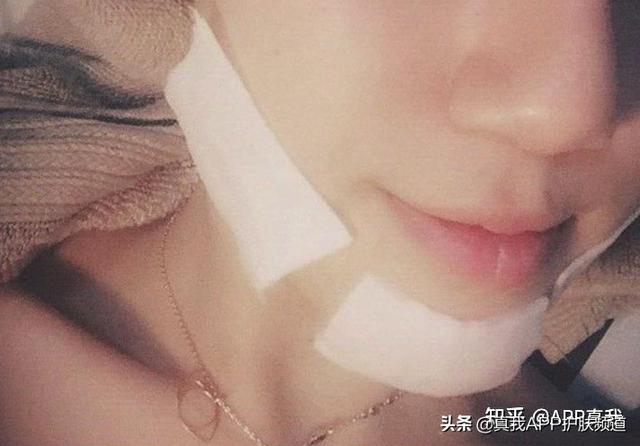 脖子上长毛周角化怎么