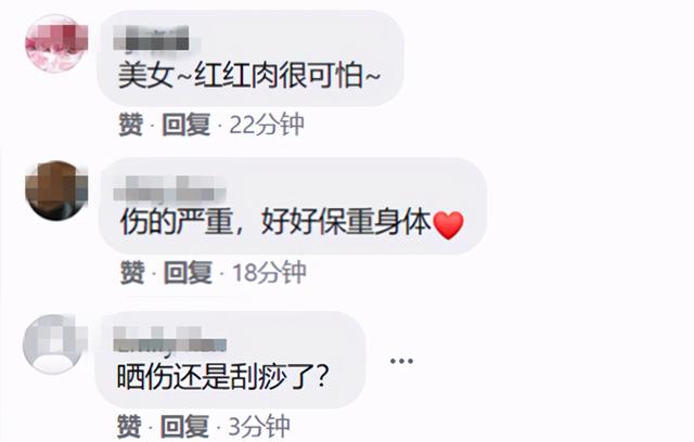 乌龙院女神叶全真晒太阳，脖子上长满红斑，触目惊心，令人担忧。
(图3)