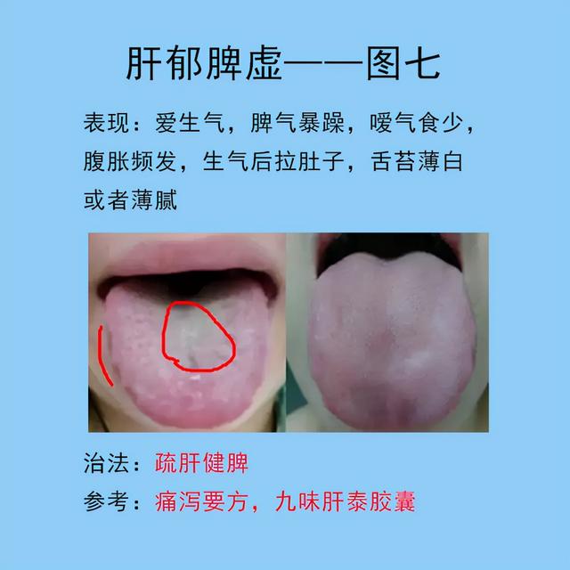 脾胃常见的10种舌象，以及临床表现，后面带解决方法