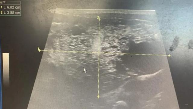 B超发现在左边，CT看着却在右侧！出生10天，宝宝腹部惊现“会运动”的拳头大肿瘤