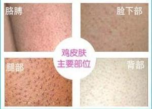 胳膊张毛周角化