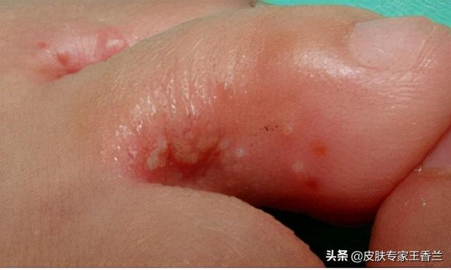 角化型脚癣最合我的治疗方法