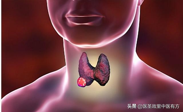 民间中药名方——消囊汤，13味药，可化痰湿、通气血、消囊肿