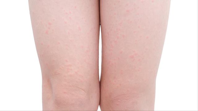 怎样治鸡皮肤色素推荐