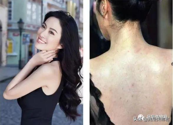 背上长了很多痘痘用什么身体乳