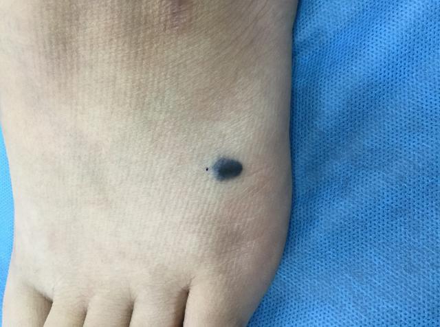 脂溢性角化病与肠胃癌