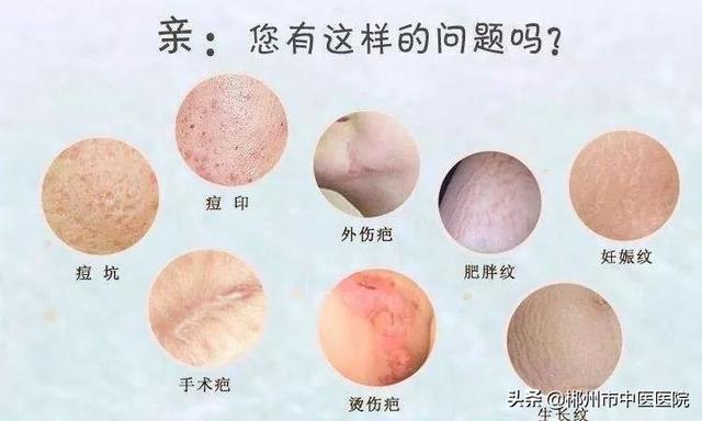 脂溢性角化病激光后留疤吗