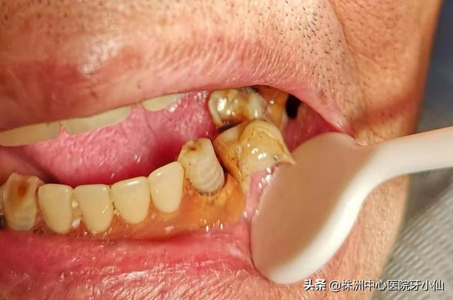 口腔颊白色角化吃什么