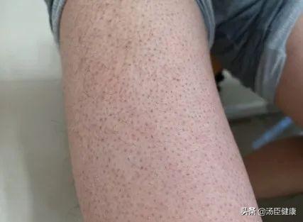 红色红点摸起来有点像鸡皮疙瘩