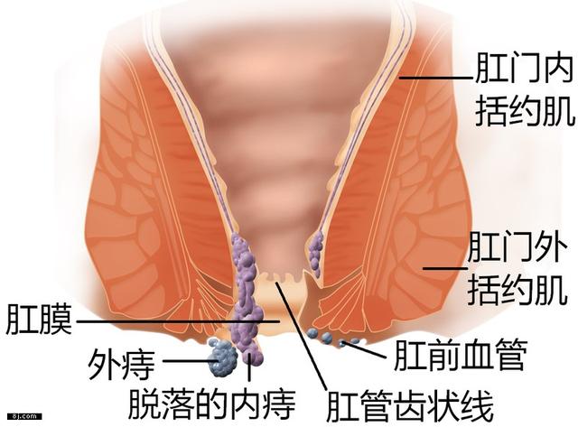 痔疮怎么办