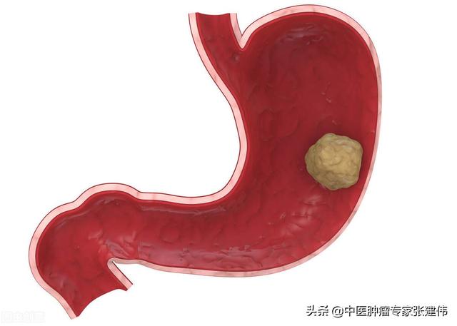 胃潰瘍反復發作？當心！這幾種“胃病”可能會惡變成胃癌