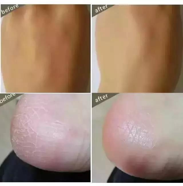 冬天局部皮肤瘙痒鸡皮