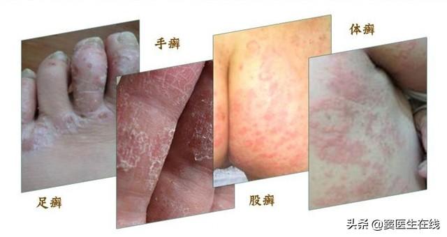角化型脚气可以撕皮吗