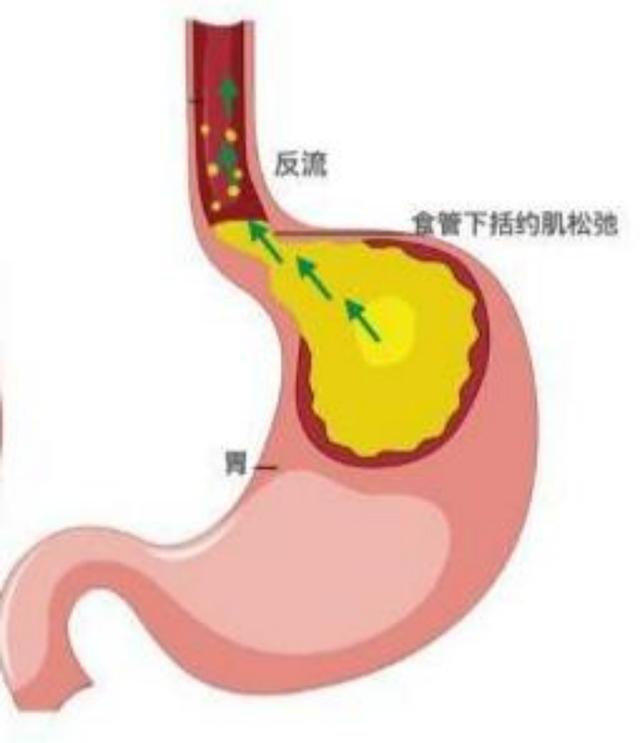 病在肝胆，症见于胃，胃食管反流病从肝论治