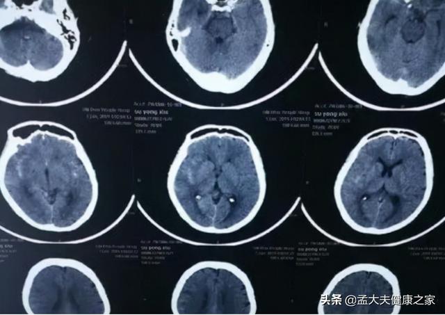 奥美拉唑一停，反酸、烧心就容易复发该怎么办？怎样能避免？