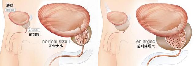 前列腺肥大症状