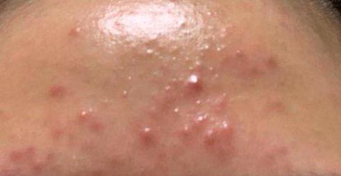 脸上长痘毛囊角化