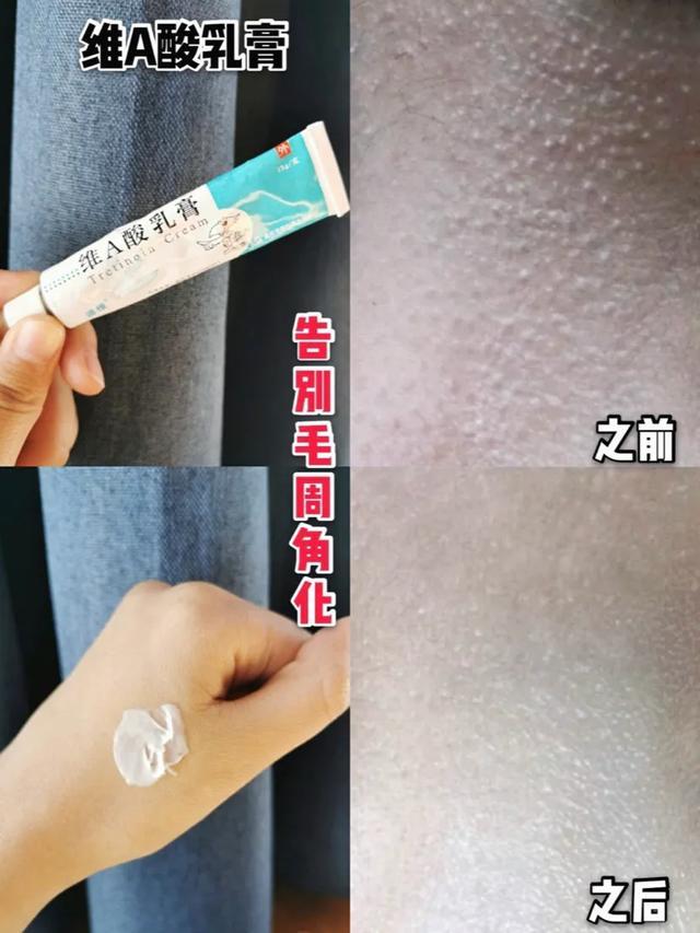 维a酸乳膏可以去周角化