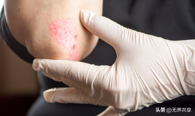 牛皮癣用什么身体乳