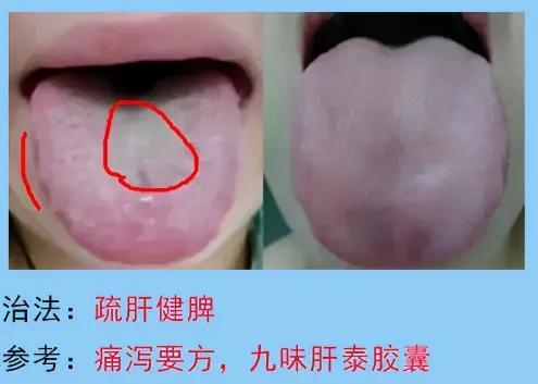 脾胃病的常见舌苔分析，脾胃不好的人要多多了解，你是图几？