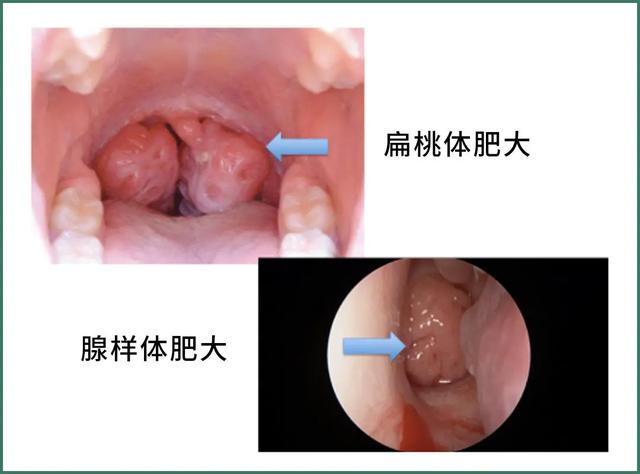 孩子张口呼吸，到底是怎么回事？真的会越睡越丑吗？