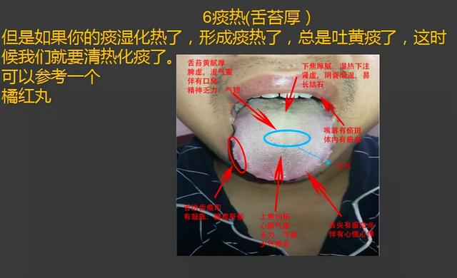 齿痕重是脾虚，舌苔厚也是脾虚吗？怎样把舌苔变薄、齿痕消失呢？