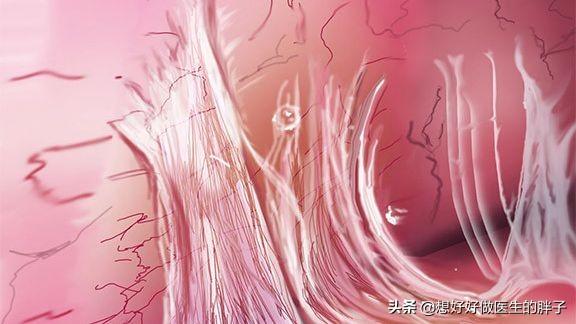 筋膜炎令病人痛苦不堪,但治疗不能急,步步为营会获得最佳效果