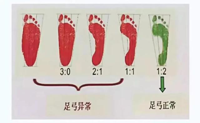 这8种凉鞋千万别给孩子穿！伤了骨头后悔就晚了