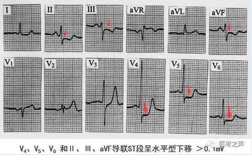 两种中成药，多靶点“清理血液”，从根上疏通冠脉，改善心肌缺血