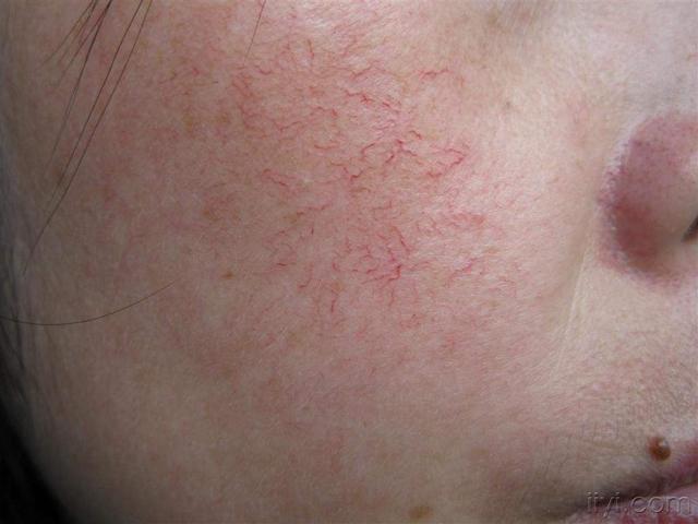 冬天常见皮肤问题的辨别治疗与预防