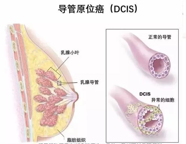 聯合檢查，讓乳腺導管原位癌無處可逃