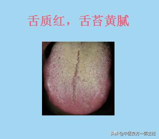 临床常见的9种舌象，对照自测