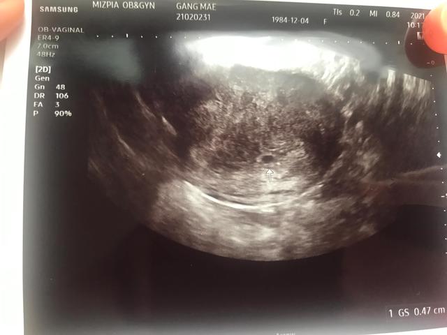 艰难的二胎路（双胞胎失败）