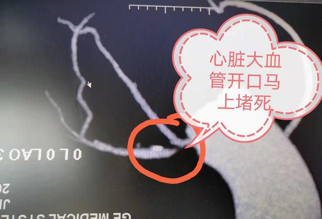 脖子发紧，医生说心脏血管堵了，得做造影看看，患者要求先做CT