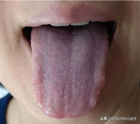 春季养肝正当时，逍遥丸、越鞠丸、柴胡舒肝丸，如何通过舌象选？