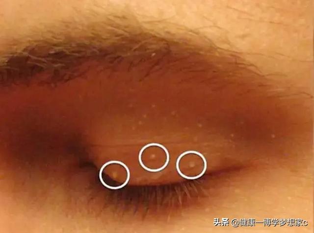 眼睛周围的脂肪粒其实是粟丘疹,教你两个方法轻松祛除它