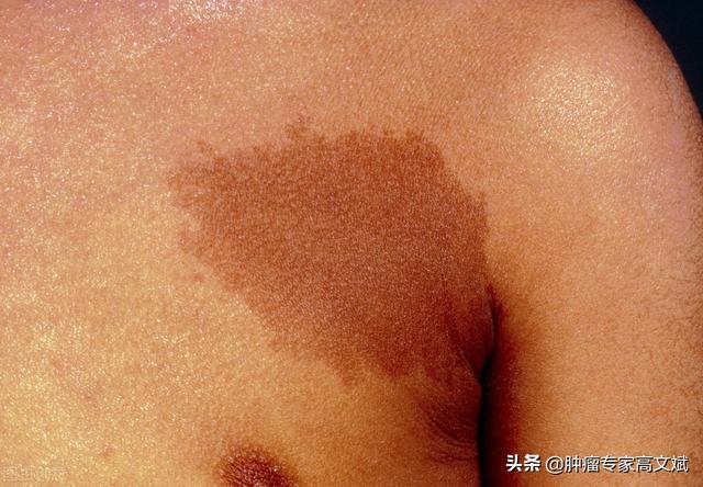 “牛奶斑”“泡泡宝贝”这些可能都是肿瘤的表现